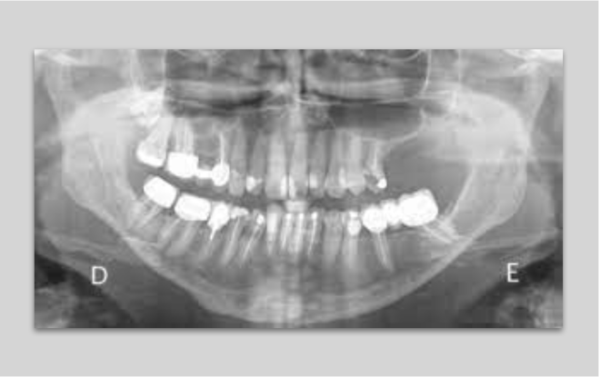 Nova esperança para doentes com perda óssea grave