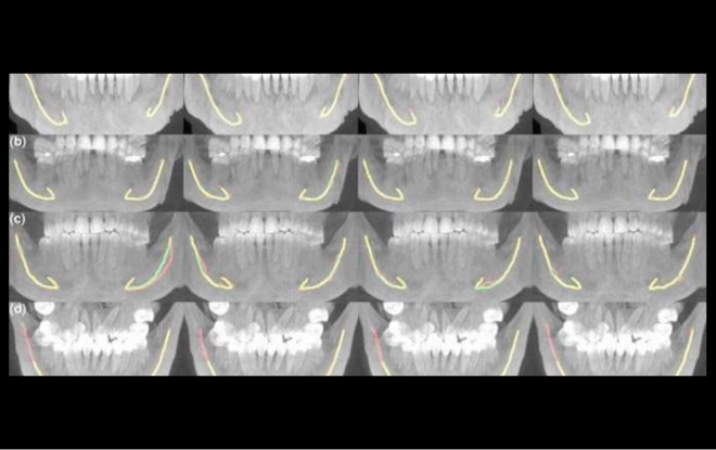 Inteligência artificial auxilia no atendimento odontológico e cirurgia da mandíbula