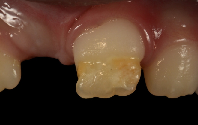 Defeitos genéticos levam a malformações do esmalte