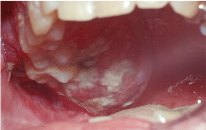 Prevenção do Cancro Oral: Um importante recurso de aprendizagem gratuita