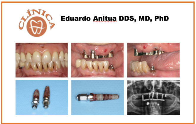 Implante reimplantado no setor estético. Previsibilidade e resultados a 10 anos