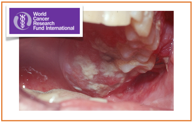 Estatísticas sobre o cancro da boca e oral