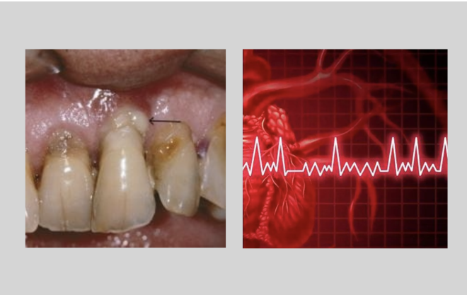 Infeção gengival pode ser um dos fatores de risco para arritmia cardíaca