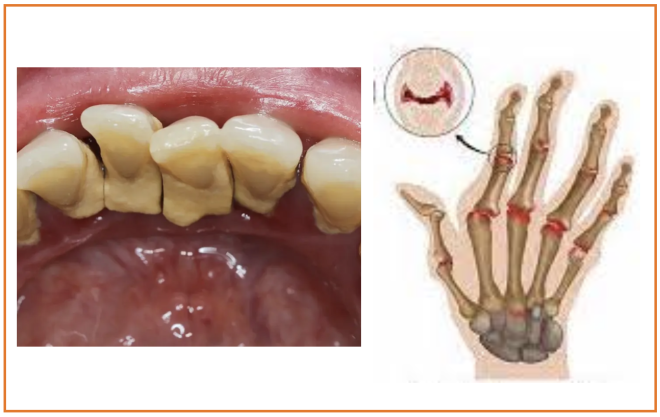 Estudo sugere via causal entre doença gengival e artrite reumatoide