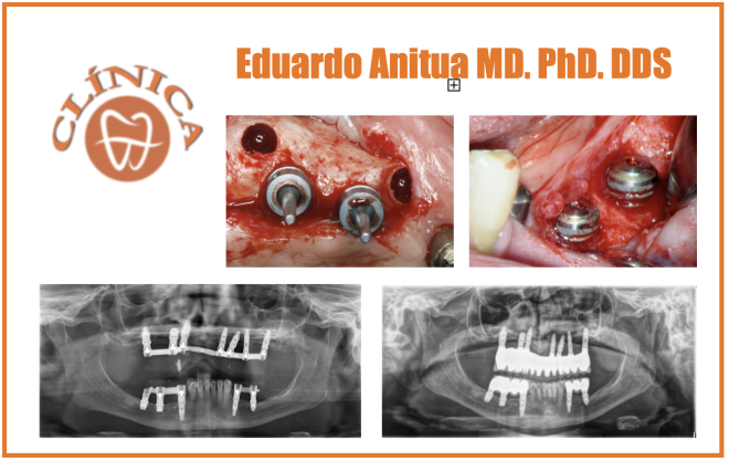 Substituição atraumática de implantes mal posicionados afectados por peri-implantite. Caso clínico com seguimento de 12 anos