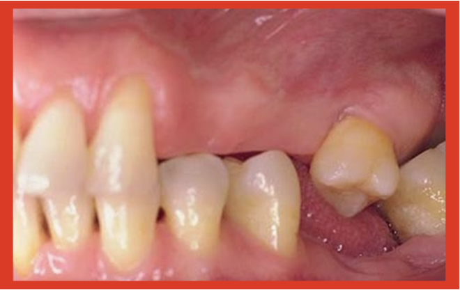 Estudos mostram forte ligação entre perda dentária e doença inflamatória intestinal