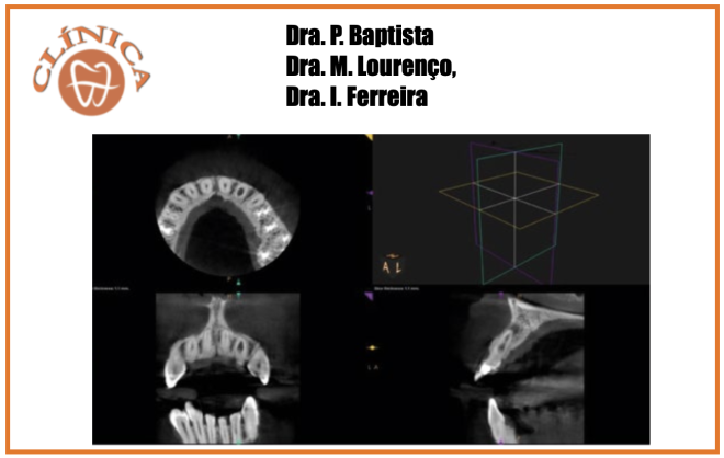 Caso clínico: Reabsorção interna dente 22