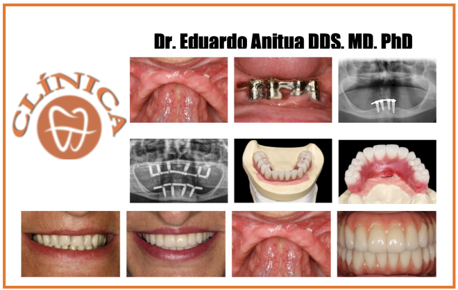 Dr. Eduardo Anitua DDS, MD, PhD - Caso Clínico