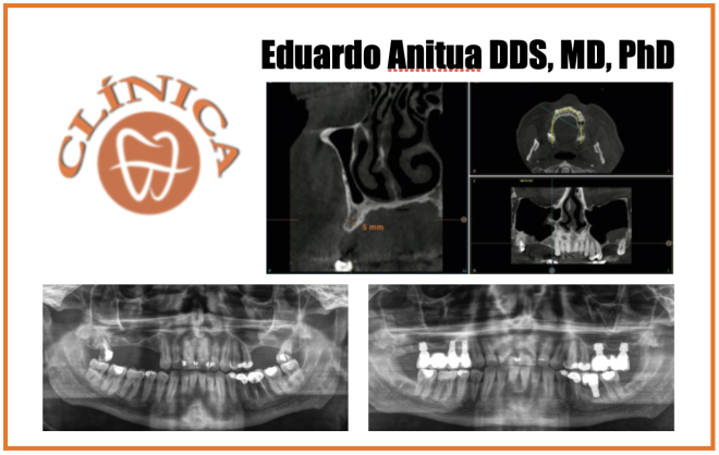 Atrofia bilateral máxima posterior grave. Abordagem dupla  minimamente invasiva para o seio maxilar