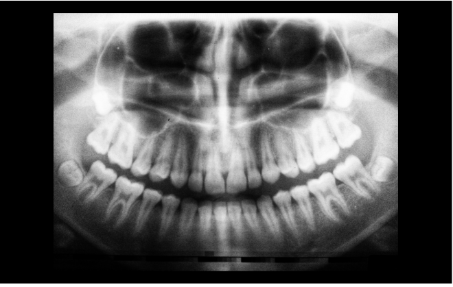 Cancro Oral  e a Inteligência Artificial