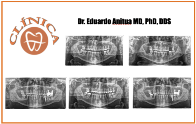 Menos é mais. Implantes de plataforma ultracurta e estreita. Novas terapias para novos tempos.