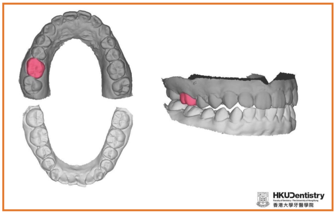 Próteses dentárias de um único molar projetadas por IA