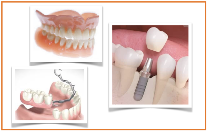 Estudo examina se substituições de dentes perdidos diminuem o risco de deficiência cognitiva