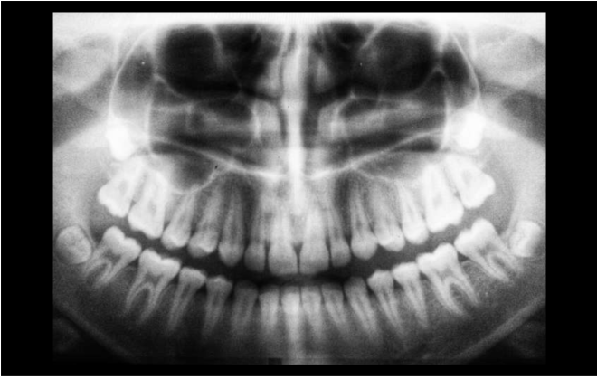 Apneia obstrutiva do sono ligada a ossos e dentes mais fracos em adultos