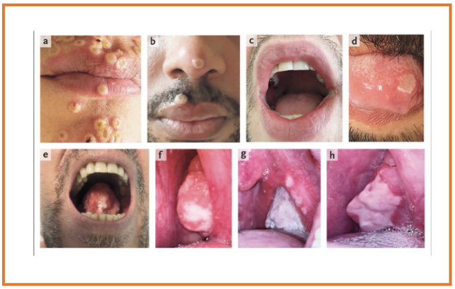 Quais são as implicações do surto de varíola dos macacos para o exercício da medicina dentária?