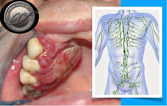 O número de nódulos metastáticos é um indicador de sobrevivência no cancro oral