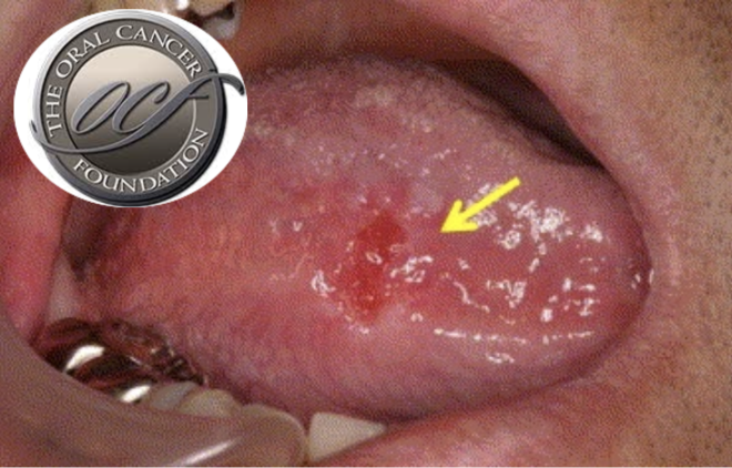 Diagnóstico e tratamento do cancro da língua