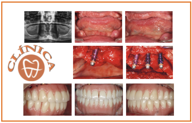 Caso Clínico - Dr. Eduardo Anitua DDS, MD, PhD