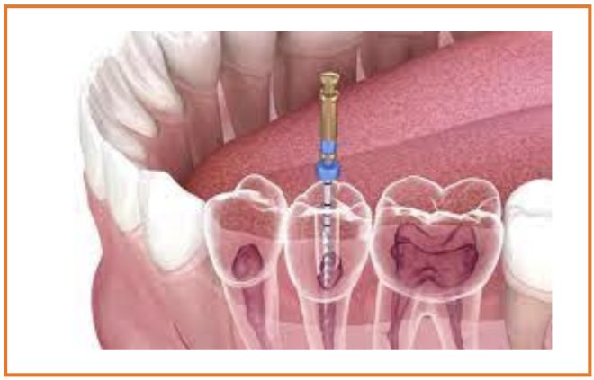 Biomaterial poderá vir a  manter o dente vivo após o tratamento de canal radicular