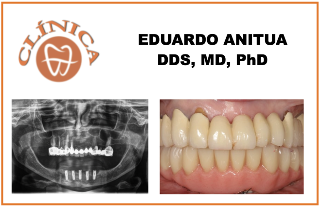 A importância das técnicas minimamente invasivas na restauração dentária. O caso de implantes curtos e das facetas cerâmicas. A propósito de um caso