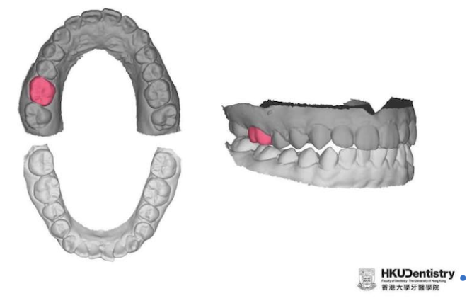 Próteses dentárias monomolares projetadas por IA