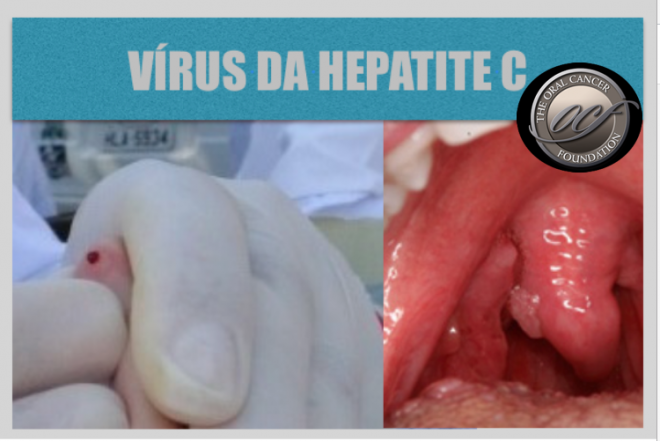 Estudo mostra ligação do Vírus da Hepatite C ao cancro da cabeça e pescoço