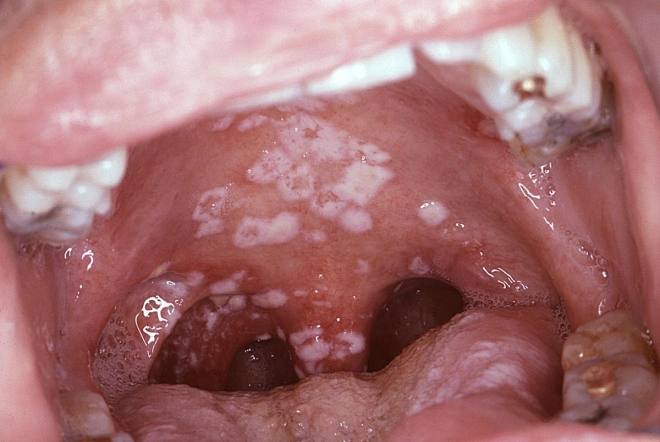 Os antibióticos  destroem as “bactérias boas” piorando a infeção oral