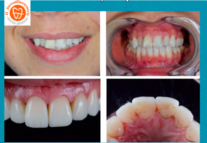 Facetas em dissilicato de lítio- Caso Clínico