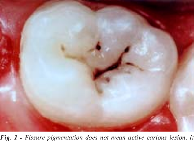 Estudo explora o uso de algoritmo de “deep learning” para detetar cárie oclusal