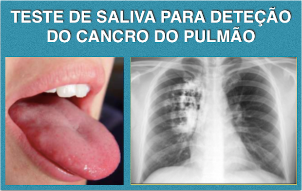 TESTE DE SALIVA PARA DETEÇÃO DO CANCRO DE PULMÃO DESENVOLVIDO POR MÉDICOS DENTISTAS