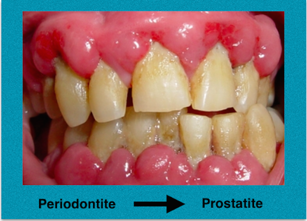 ESTUDO  MOSTRA UMA LIGAÇÃO ENTRE PERIODONTITE E PROSTATITE