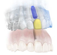 Novas oportunidades com as Digital Open Solutions de DENTSPLY Implants