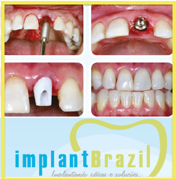 12º CURSO INTERNACIONAL INTENSIVO AVANÇADO EM IMPLANTES E ENXERTOS ÓSSEOS