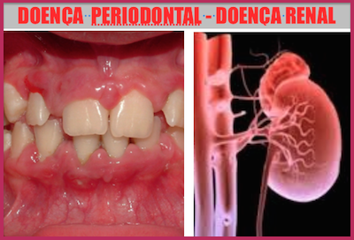 ESTUDO INVESTIGA A RELAÇÃO ENTRE SAÚDE ORAL E DOENÇA RENAL