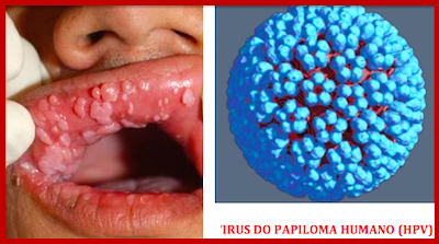 AUMENTO DA INCIDÊNCIA  DO CANCRO ORAL ASSOCIADO AO HPV