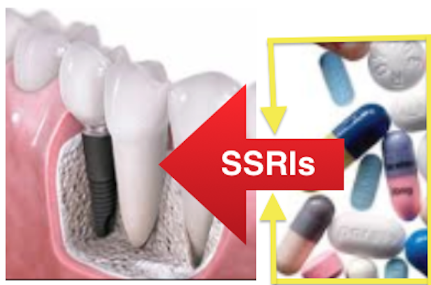 ALGUNS  MEDICAMENTOS USADOS PARA O TRATAMENTO DA DEPRESSÃO PODEM INTERFERIR COM OS IMPLANTES DENTÁRIOS DEVIDO À SSRIs