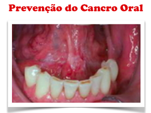 IMAGENS  DE CITOMETRIA PODEM VIR A DESEMPENHA UM PAPEL IMPORTANTE NO RASTREIO DO CANCRO ORAL