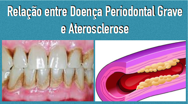 NOVO ESTUDO CONSTATA RELAÇÃO ENTRE PERDA DE DENTES E  A ATEROSCLEROSE