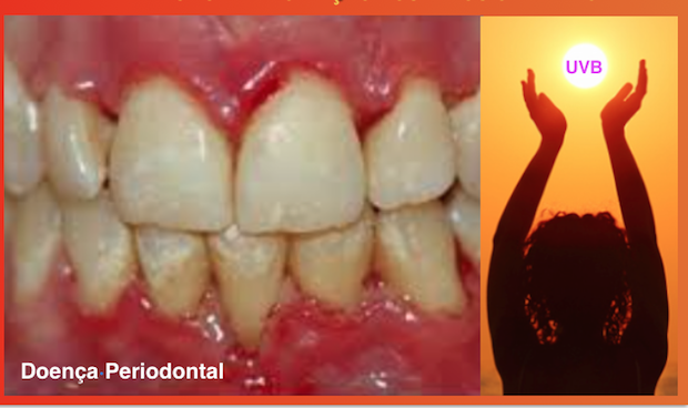 UMA MAIOR INGESTÃO DE VITAMINA D PODE INTERROMPER A PROGRESSÃO DA DOENÇA PERIODONTAL