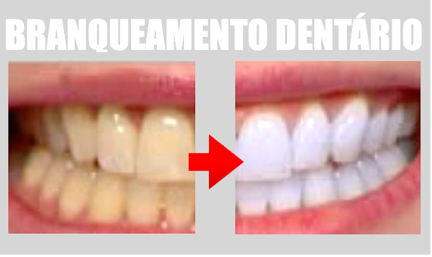 BRANQUEAMENTO DENTÁRIO – FUTURO BRILHANTE