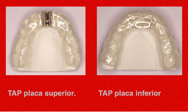 PAPEL DO MÉDICO DENTISTA NO TRATAMENTO DA RONCOPATIA E DO SÍNDROME DE APNEIA/HIPOAPNEIA OBSTRUTIVA DO SONO (Artigo Clínico)