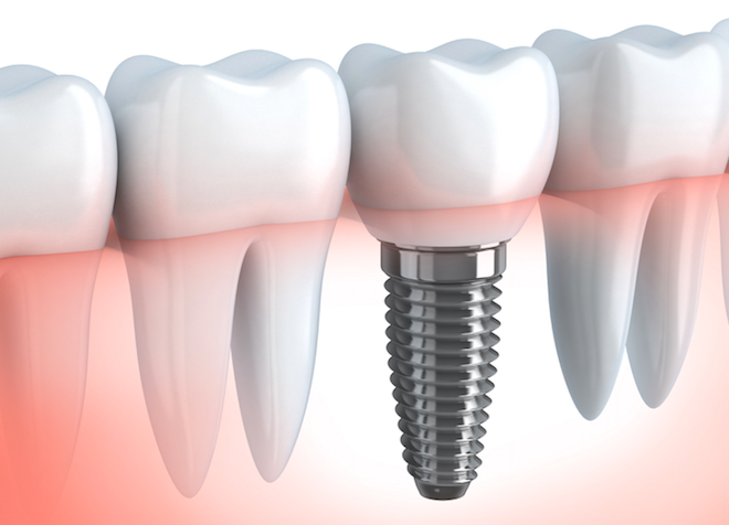 ESTUDO SUGERE QUE OS IMPLANTES DENTÁRIOS PODEM MELHORAM A  QUALIDADE DE VIDA DAS MULHERES COM OSTEOPOROSE