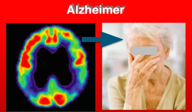 PODERÁ A SALIVA VIR A SER USADA PARA DETETAR  A DOENÇA DE ALZHEIMER?