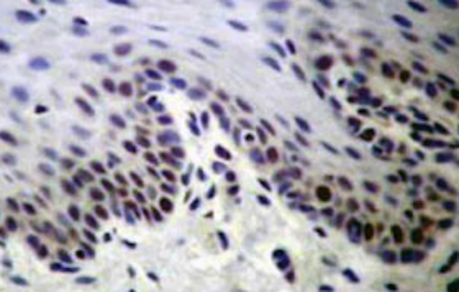 ESTUDO CONSTATA QUE A PROTEÍNA (p53)  SUPRESSORA DO CANCRO ENFRAQUECE COM O NOSSO ENVELHECIMENTO