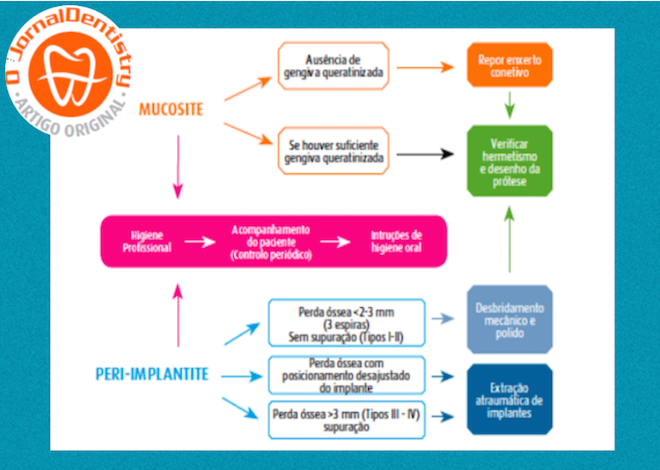 Reversibilidade Do Tratamento Implantológico. Uma Alternativa De Tratamento Para A Peri-Implantite