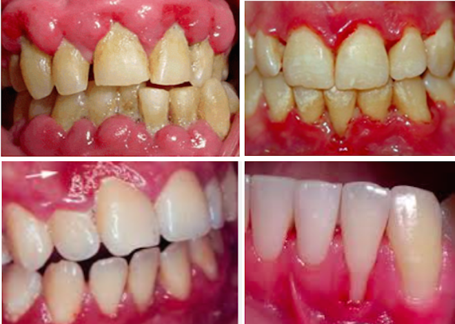 A American Dental Association Emitiu Diretrizes Sobre O Tratamento Da Periodontite Crónica